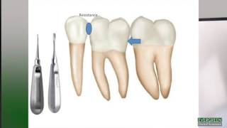 How to make molar extractions easier [upl. by Revlys550]