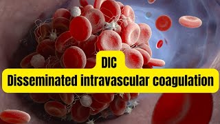 DIC Disseminated intravascular coagulation [upl. by Atinomar]