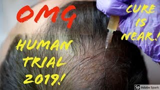 OMG HUMAN CLINICAL TRIALS TO CURE BALDNESS Dr Takashi Tsuji UPDATE [upl. by Ruthy576]