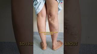 Can You Really Get Rid of Varicose Veins in Just 24 Hours [upl. by Lipson392]