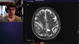 Stroke Acute infarction  radiology video tutorial CT MRI angiography [upl. by Bryn875]