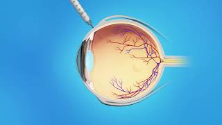 Branch Retinal Vein Occlusion Treatment  Medication Injection [upl. by Leamse]