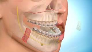 Avancée du maxillaire et recul de la mandibule [upl. by Doris]