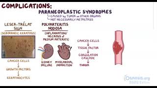 Gastric Cancer  Osmosis [upl. by Heddi]