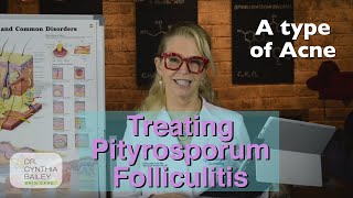 Treat Pityrosporum Folliculitis Dermatologists Tips 2019 [upl. by Pazice]