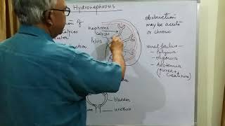 Pathology hydronephrosis part 1 [upl. by Fogg]