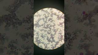 Platelet Clumping During check platelet count in microscope Platelet count in microscope platelet [upl. by Burkley]