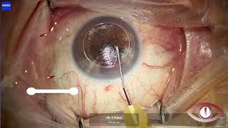 DALK Deep Anterior Lamellar Keratoplasty [upl. by Salokkin]