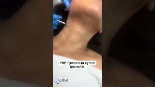 PRP Plateletrich plasma treatment prp prptreatment sugarland houstontx medspa skincare [upl. by Edobalo605]