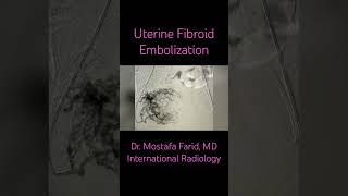 Uterine Fibroid Embolization for treatment of Fibroid Tumors of the Uterus interventionalradiology [upl. by Leverick]