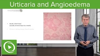 Urticaria Hives and Angioedema – Pediatrics  Lecturio [upl. by Teena]