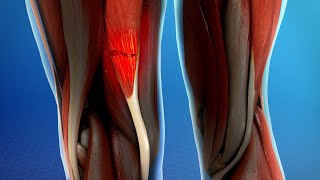 Hamstring Muscle Injuries [upl. by Frisse996]