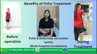 Benefits of polio treatment  polioilizarovBhola hospital polio treatment [upl. by Fortier28]