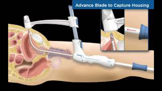 TSPeC® Illustrated Procedure  English [upl. by Sitnalta647]