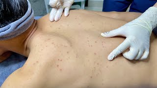 ACNE TREATMENT VU QUYNH MI Blackheads On Boy Back 2024 [upl. by Ecerahs]