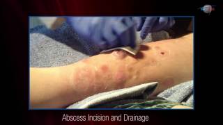 WCW Abscess Incision and Drainage [upl. by Oak]