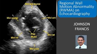 Regional Wall Motion Abnormality RWMA on Echocardiography [upl. by Ramburt]