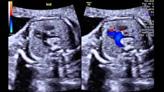 5CV of a case of double discordance congenitally corrected transposition of the great arteries [upl. by Jerrie]