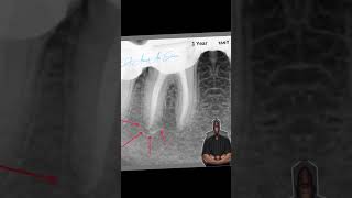 follow up1 year a case of acute periapical abcess الكربولة اكسبلور endodontics [upl. by Enimzzaj]