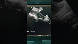 Displaced IUCD on Ultrasound medical ultrasound health pregnancy uterus familyplanning viral [upl. by Nahtonoj]