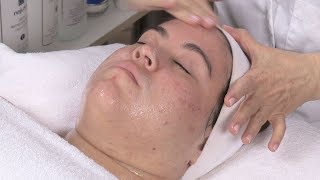 Diet Related Acne And Facial With Alessandra Part 3 [upl. by Seidel260]