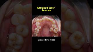 Braces time lapse crooked teeth transformation braces orthodontist brackets dentist dentistry [upl. by Annuhsal]