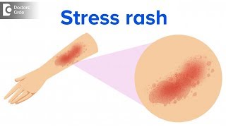 What is a stress rash  Dr Rajdeep Mysore [upl. by Durham556]