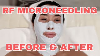 BUILDING COLLAGEN RF Microneedling Results [upl. by Farman222]