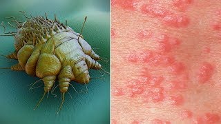 What is Scabies Causes Pictures Images Signs and Symptoms of Scabies [upl. by Gathers]