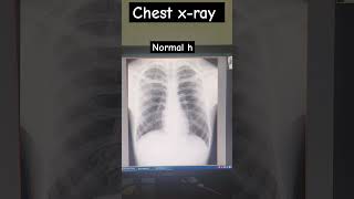 chest xray xraytechnician hospital short video [upl. by Pallua]