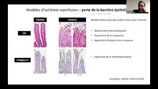 Ischémie mésentérique  Simon BOURCIER [upl. by Tessie]