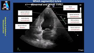 Wall Motion Abnormality Part II cases amp practice [upl. by Yrelle]