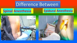 Difference between Spinal Anesthesia and Epidural Anesthesia [upl. by Nohsyt518]