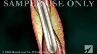 Balloon Angioplasty  ANC00203 [upl. by Honna297]