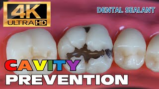 HOW TO PREVENT CAVITIES DENTAL SEALANT [upl. by Adidnere]