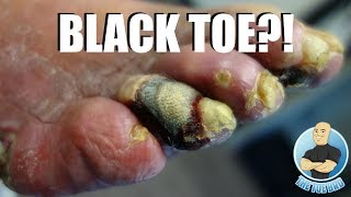 GANGRENE TOE ON A DIABETIC PATIENT [upl. by Remmus293]