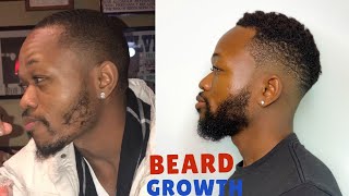 HOW I GREW MY BEARD USING MINOXIDIL  GET RID OF PATCHY BEARD [upl. by Iran]