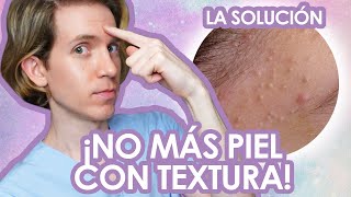 Como ELIMINAR los COMEDONES CERRADOS  Fácil y efectivo  Recomendaciones de un dermatologo [upl. by Bobbi]