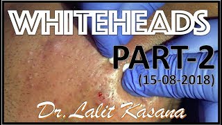 ANTI ACNE TREATMENT PART2 BY DRLALIT KASANA15082018 [upl. by Nivra]