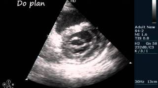 MSMR RHD ECHOCARDIOGRAPHY SERIES BY DRANKURKCHAUDHARI [upl. by Derrej119]