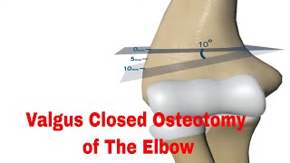 Valgus closed osteotomy of the elbow [upl. by Ubald203]