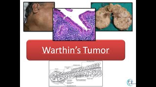 Warthins tumor [upl. by Daile]