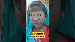 Xeroderma Pigmentosum  DermaCase  Basal cell amp Squamous cell Carcinoma  Sun induced Pigmentation [upl. by Eiduj18]