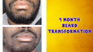 Minoxidil Beard Transformation [upl. by Atalee769]