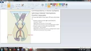 Psychology 306 Biopsychology  Chapter 16 Commissurotomy in Human Epileptics [upl. by Matazzoni]