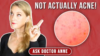 Fungal Acne Treatment and Prevention Tips for Clear Skin  Doctor Anne [upl. by Neyuq]