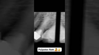 Pulpotec Retreatment Case full Steps الكربولة [upl. by Atiuqad]