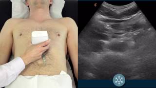 How to scan the abdominal aorta to assess for a potential AAA [upl. by Manley]