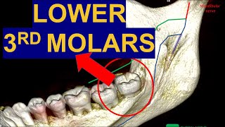 Secrets of Impacted Lower Third Molars CBCT Surgical extraction of wisdom teeth removal surgery [upl. by Rakso]