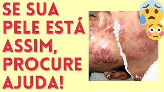 Quando você PRECISA tomar antibióticos contra a acne  O que é Staph Infection e porque é perigoso [upl. by Sewellyn]